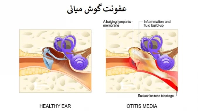 عفونت گوش میانی در کودکان ، درمان ، روش های تشخیص و علائم آن