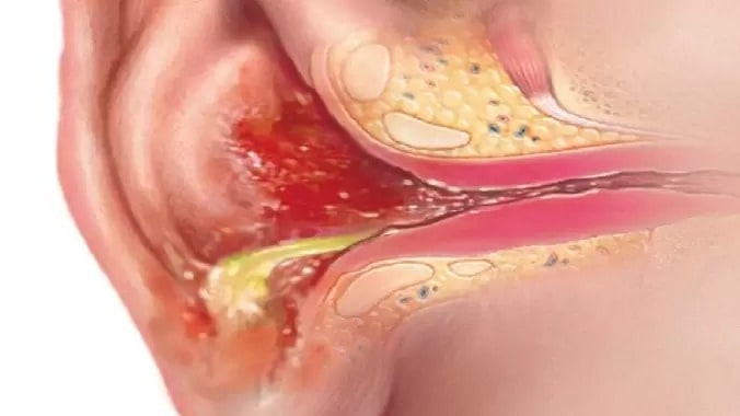 علت و علائم عفونت گوش خارجی چیست و چه عوارضی دارد؟