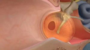 پارگی پرده گوش