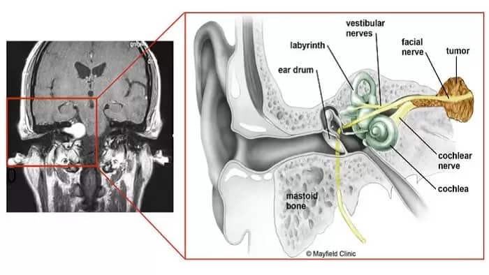 تومور گوش یا تومور عصب شنوایی (نورینوم آکوستیک)