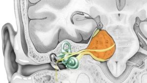 تومور گوش- تومور عصب