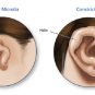 بد شکلی گوش نوزادان | جراحی آترزی گوش و درمان بد شکلی