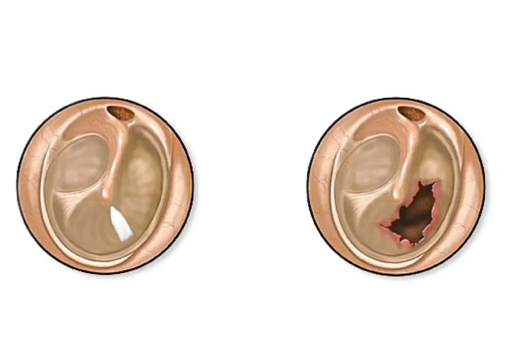 نشانه های پرده گوش آسیب دیده