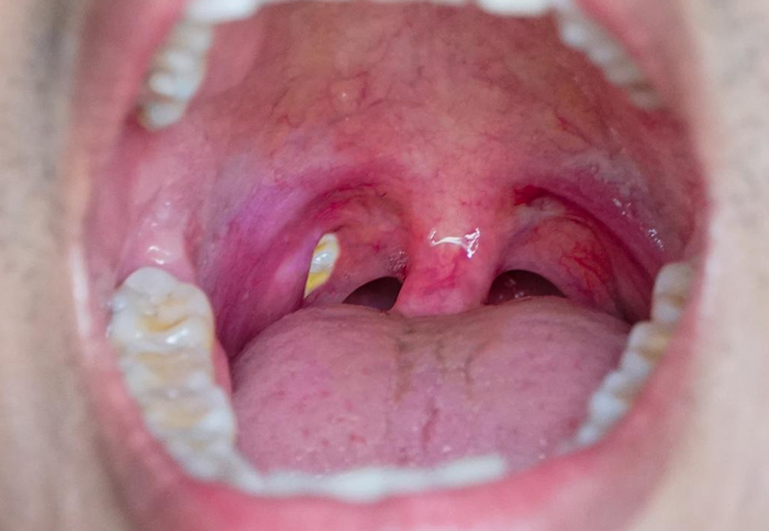 علت کیست لوزه