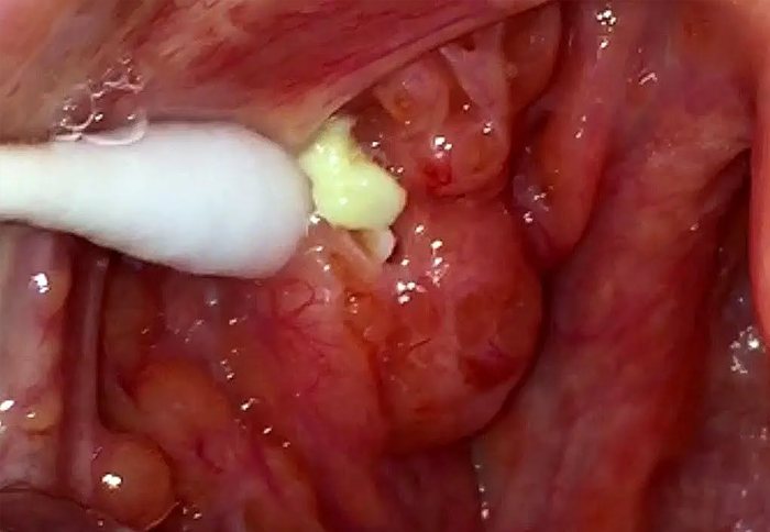 تفاوت سرطان لوزه با کیست لوزه چیست