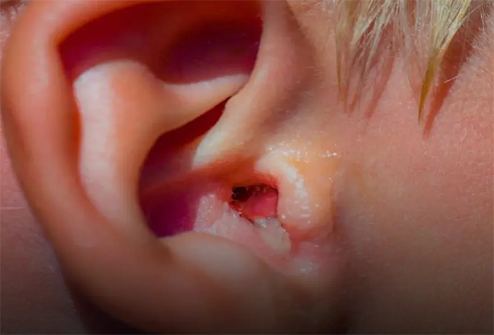 قارچ گوش چیست؟