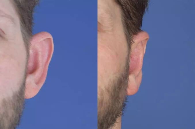 بیرون زدگی لاله گوش