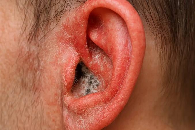 قارچ گوش چیست