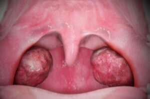 کیست لوزه چیست